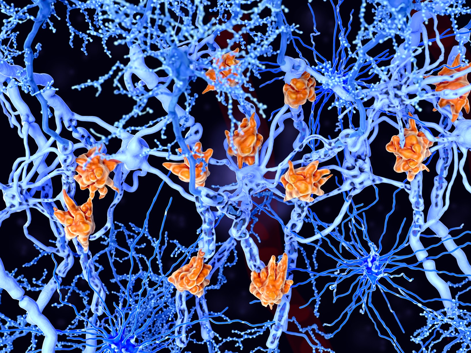 Kuvituskuva: Mikrogliasolut vahingoittavat hermosoluja 